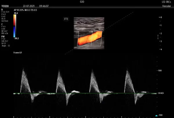 TE X Portable Ultrasound System - Image 2