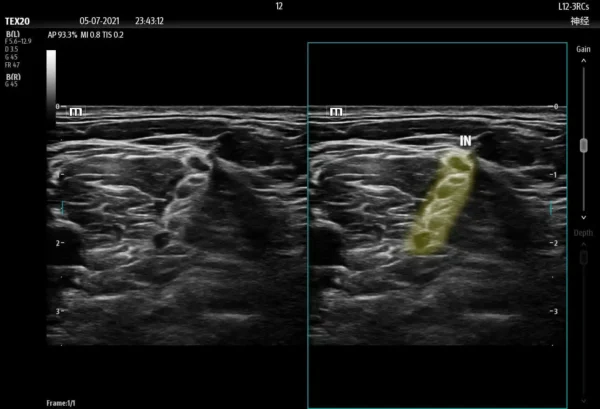 TE X Portable Ultrasound System - Image 3